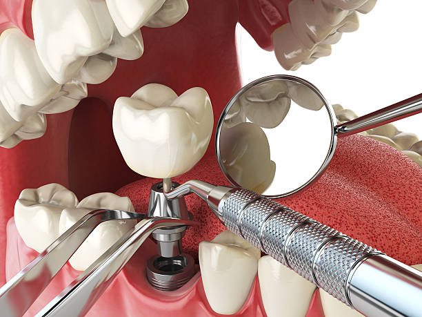 Best Lost Filling or Crown Replacement in Hasley Nyon, CA